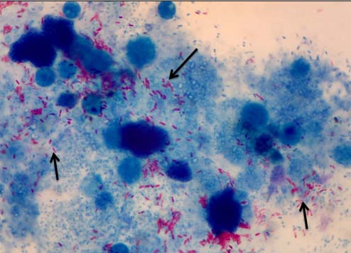 Figure 2: Histopathological features of AFB stained tissue biopsy