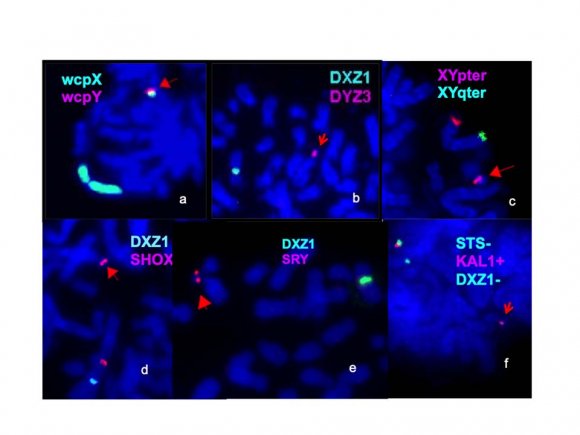 Figure 2: FISH results for P1. Partial metaphases showing the presence of: a) both signals of wcpX and wcpY (red arrow) indicating the participation of X and Y chromosomes in complex sSMC; b) two copies of DYZ3 (red arrow); c) two copies of XYpter (red arrow); d) two copies of SHOX (red arrow); e) two copies of SRY (red arrow) and f) one copy of STS/ KAL1 (red arrow).