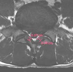 Figure1: Guide k-wire inserted thought the skin lateral (if lateral incision) to the bone. The surgeon is able to feel it so a straight line is easier to do with the Shannon burr. K-wire is positioned in the limit of the "safe zone" which is half way between calcaneal spur and fibula.