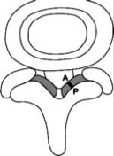 Figure 1.1: Measurements of ligamentum flavum A Total of 180 ligamentum flavum was measured in 47 patients.The right and left ligamentum flavum (LF) for the involved vertebral level was measured. Thickness at the middle portion of ligamentum flavum was measured. All measurements were taken by two persons separately and mean was calculated.A total of 87 ligamentum flavum were harvested, using a standardized technique. Ligamentum flavum tissue was harvested at L3 -L4 in 13 patients, L4 -L5 in 38 patients and at L5 -S1 in 36 patients (Table. 5) from