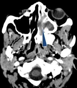 Figure 1: Left sinusitis on A (arrowhead A). A left peritonsillar abscess on B (arrow). The figure C a drained Bezold's abscess in a child complicated by lateral sinus thrombosis. Osteitis of the petrous apex (thick arrow C) and close to the sigmoid sinuse (thin arrow C). The figure D shows a facial cellulitis (arrowhead D) and sinusitis (star D) in a patient with diabetic type 1 patient (arrow head D) complicated with a right purulent eye, septic thrombosis of the cavernous sinus (arrow D) and cerebral abscesses.