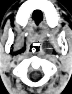 Figure 5: Sagittale MPR reconstruction of an injected brain CT showing a thrombus on the torcular (arrow A). The thin MIP reconstruction shows a defect within the venous sinuse (arrow B). Notice that the thrombus is worse defined than on MPR image on B.