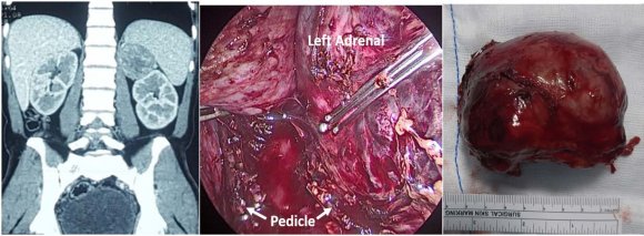 Competing interests: The authors declare no competing interests.Funding: No funds were used to study this case.Authors' contributions: J.G.R and D.T.S operated the patient with a laparoscopic nephrectomy. A.A.B. made the diagnosis of vaginall metastasis and L.M.P contribute to the revision of the manuscript and the literature. P.G.P performed the anatomopathological In this study they demonstrated angiographically that the contrast flow retrograde from the left renal vein on the left ovarian vein, the uterovaginal plexus and therefore the right ovarian vein.
