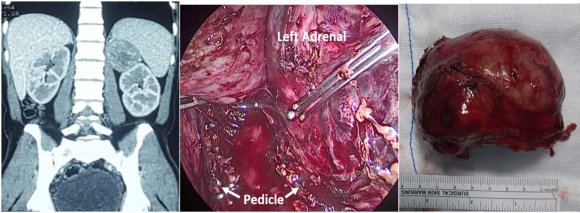 Figure 1: (a) CECT abdomen of Left Adrenal tumor; (b) Laparoscopic adrenalectomy-division of pedicles; (c) Resected specimen of left adrenal tumor
