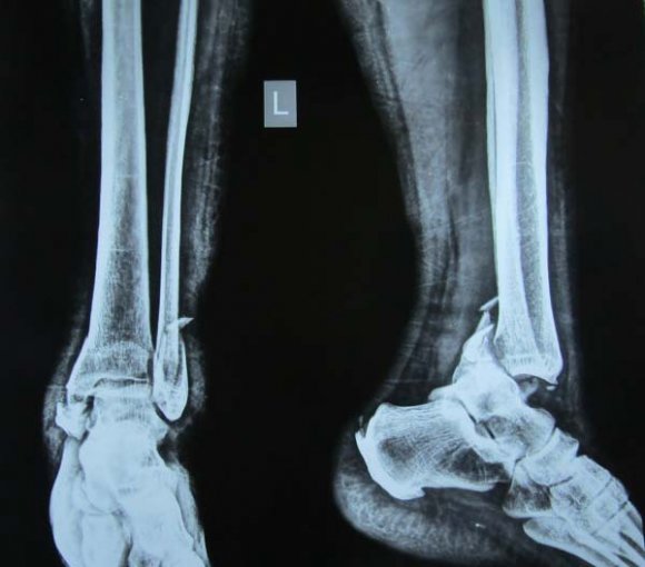 No cast immobilization or bracing was used after the surgery. The patient began a passive and active range of motion exercises immediately.