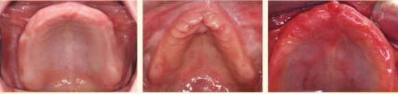 Fig. 3: PFM Vs Hybrid Prosthesis after Full Mouth Implant Therapy