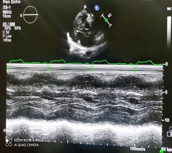 Figure 3: a-TTE Short-axis view showing a mitral valve area of 0.5 cm2 measured by planimetry, b-Apical 4 chamber view revealing a mean gradient (MPG) of 18 mmHg associated with a moderate mitral regurgitation.