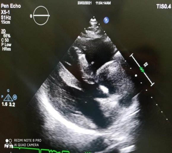 Figure 4: TTE sub-costal view showing left atrial spontaneous echo contrast and a non-restrictive ostiumsecondum ASD measuring 11mm with bidirectional shunt.