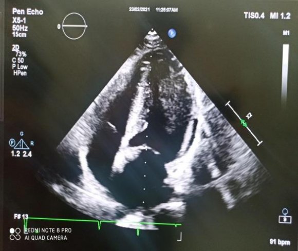 Figure 5: TEE showing a non-restrictive ASD in addition to a severe MS and a spontaneous contrast in the LA. 6 Year 2021