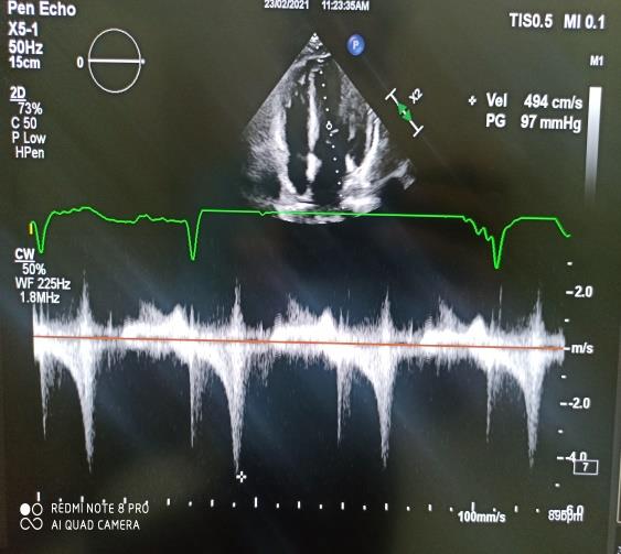 Madelung Deformity: Surgical Correction with Radial Dome Osteotomy