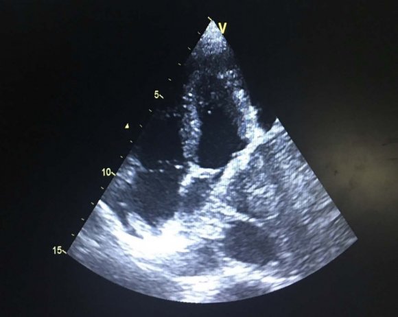 peripheral superior and inferior limbs(5) Its exact incidence is unknown and treatment depends on the etiology. Chest radiography showed a mass over the right lower lung, A CT scan confirmed the x-ray image with the mass compressing along the right lower pulmonary vein. Transthoracic echocardiography revealed a left atrium compressed by a mediastinal tissue mass (Fig 1) with acceleration of pulmonary venous flow on doppler (Fig 2-3) associated with a low abundance pericardial effusion