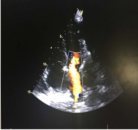 Figure 1: Left atrium compressed by mediastinal mass on transthoracic echocardiography