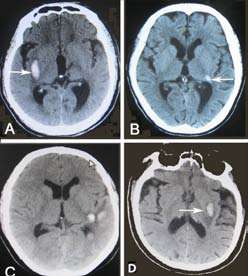 Figure 1: Head CT of acute insular lobe hemorrhage in 15 of 70 patients with central AVS. Here, 4 images were selected that were representative of different topographical regions involved. The median-posterior insular cortex hemorrhage (A, B, C, and D, arrows) shows the features of forming a small elliptical hematoma with AVS.