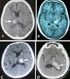 Figure 2: Head imaging (CT or MRI) showing acute thalamic hemorrhage in 15 of 70 patients with central AVS. Here, 4 images that were representative of different topographical region involved were selected. Thalamic hemorrhage with AVS (A, B, C, D, arrows). The infratentorial ICH leading to an AVS included the brainstem in 10 cases and cerebellum in 12 cases.b) Study vestibular stations rockingThe images docking test: the images of 3 cases with left posterolateral thalamic hemorrhage with AVS and 3 cases with left insular hemorrhage with AVS were successfully docked in zero distance. (Figure3. A, B, and C) Whereas, the images of 3 patients with left posterolateral thalamic hemorrhage with AVS and 3 patients with left parietal/temporal lobe hemorrhage with