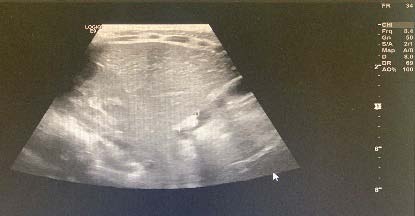 Figure 2: Low power microscopy view demonstrating a deifferentiated liposarcoma