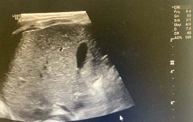 Figure 3: A microscopic view of a lipoblast, which may or may not be present in a liposarcoma