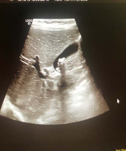 Figure 4: A multinucleated stromal cell which is present in a Sclerosing atypical lipomatous tumour during microscopy