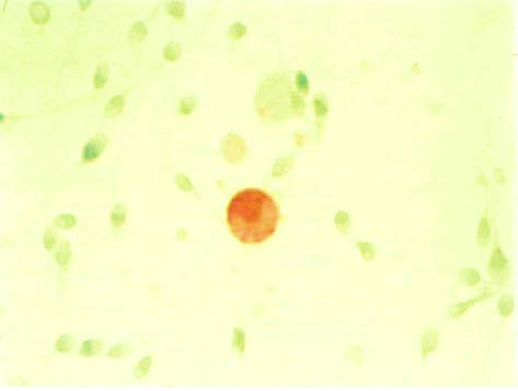 Figure 4: Management of semen samples obtained from leukocytospermic infertile males [23].