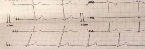 Figure 1: Electrocardiogram showing sinus bradycardia.