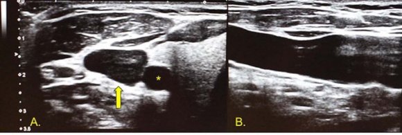 Scheme 1: Technical considerations in the axial and longitudinal axis of the transducer and vascular structure.