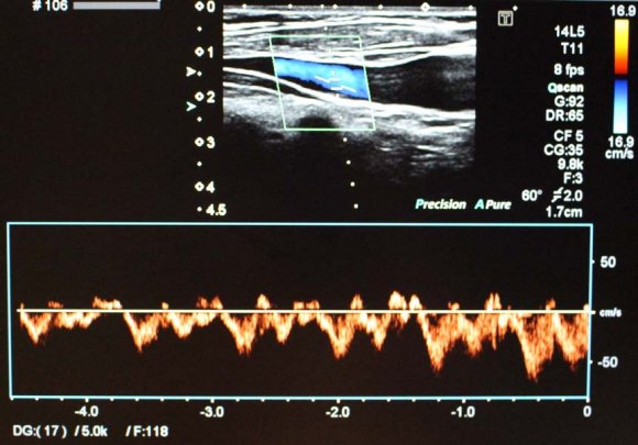 Transverse (A) and longitudinal (B) images of the internal jugular vein, the tip of the needle is identified as a linear echogenic structure.