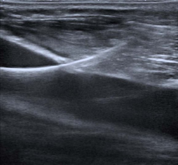 Scheme by William Prada. Scheme 3: Anatomical relationships of the femoral vein on the axial axis.