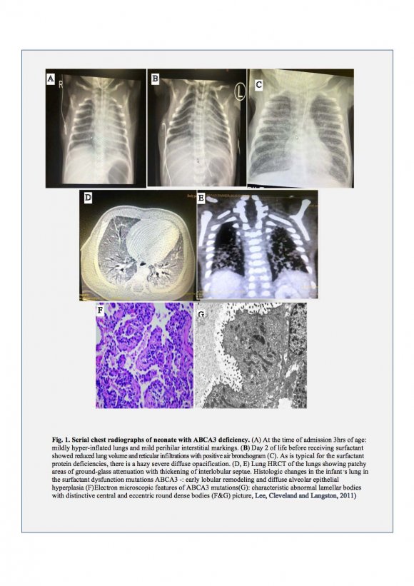 Novel Homozygous Mutation ABCA3gene: Presented as Sever Respiratory Distress Syndrome in a Term Neonate