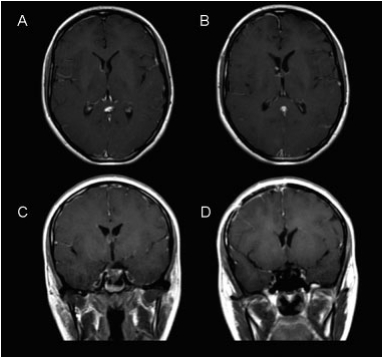 Rare Case of Young Patient with Intraventricular Angiomatous Meningioma