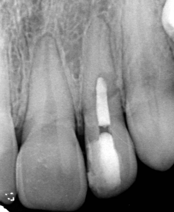 Figure 6: Rounded or elongated forms of Tetrahymena in the presence of orthodontic archwires objectifying their cytotoxicity c) Effect of the different types of extracts of Syzygium aromaticum and Celtis australis on the cytotoxicity of the wires The protozoan was cultured in artificial saliva previously incubated, for 15 days, in the presence of NiTi or CuNiTi wires and the different types of extracts of Syzygium aromaticum and Celtis australis.