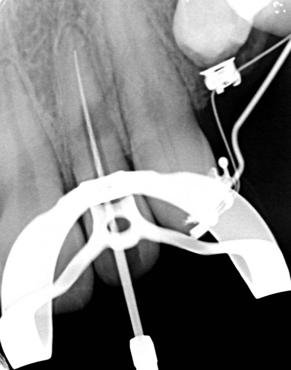 Comprehensive Diagnosis of an Invaginated Tooth Prior to Endodontic ...