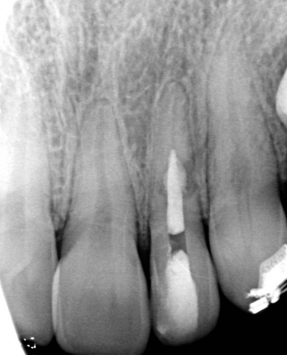 Comprehensive Diagnosis of an Invaginated Tooth Prior to Endodontic ...