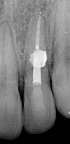 Comprehensive Diagnosis of an Invaginated Tooth Prior to Endodontic ...