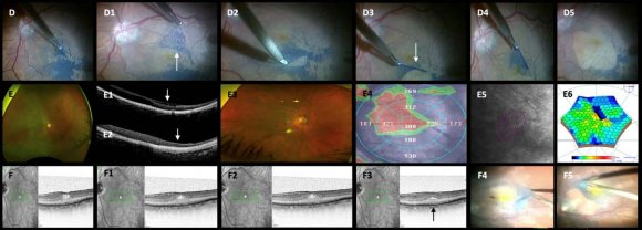 Alteration of Thyroid Hormone Pictures in Absence of Clinically Evident Thyroid Diseases among Type 2 Diabetic Subjects in a Bangladeshi Population