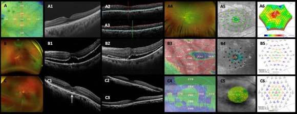 Figure 2: Postoperative structural and functional findings (part 1). (A)-(A-5) Normal control eye. (B) Primary rhegmatogenous retinal detachment (RRD); large posterior rolled edge retinal tear at 2 o'clock meridian managed with primary vitrectomy (case 2; non-peeling group). (B-1) Spectral-domain optical coherence tomography (SD-OCT) horizontal scan with postoperative subretinal fluid (SRF) 3 weeks after vitrectomy. (B-2) Shallow amount of SRF 8 weeks later. (B-3) Abnormal topographic thickness retinal map on Ret-vue SD-OCT with diffuse retinal thickening. (B-4) Macular microperimetry showing eccentric foveal fixation. (B-5) Corresponding multifocal electroretinogram (mfERG) depicting abnormal electrical response in three central rings with the nV decreased; final best-corrected visual acuity (BCVA) is 0.18 logarithm of the minimum angle of resolution (logMAR) units. (C) An Optos photo showing primary RRD involving the macula; arrow-shaped retinal tears are seen at 7 o'clock, and there is preoperative epiretinal membrane (ERM) proliferation (case 87; peeling group). (C1) SD-OCT image 8 weeks postoperatively depicting defects in the ellipsoid and external limiting membrane (ELM) disruption (white arrow). (C-2) and (C-3) Macula crossline scans, with an ellipsoid and ELM biomarkers recovered. (C-4) Postoperative normal topographic thickness macula map after undergoing a successful, two-step ERM-internal limiting membrane (ILM) removal technique. (C-5) Macular microperimetry with macula retinal sensitivity, foveal retinal sensitivity, and a stable foveocentral fixation pattern; the retinal sensitivity analysis map shows normal macular integrity at the end of the follow-up. (C-6) mfERG of the corresponding macular area. The P1 implicit time is normal in the <2-degree central ring and slightly longer in the remaining central rings. The nV amplitude in the normal range is comparable to the normal age-matched control eye, and the BCVA is 20/40 (0.30 logMAR units). (D)-(D-5) Sequence of macular ERM-ILM two-step removal technique events.