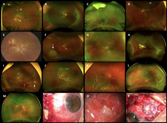Figure 3: Transoperative and postoperative buckle complications. (A) and (B) Buckled rhegmatogenous retinal detachment (RRD) (cases 4 and 58); final best-corrected visual acuity (BCVA) is 0.18 logarithm of the minimum angle of resolution (logMAR). (C) Whitish condensed vitreous hemorrhage; a recurrent RRD is detected; the eye underwent vitrectomy. Six weeks after, retina remains attached with epiretinal membrane (ERM); logMAR is 0.60 (D) Buckled eye with 15% sulfur hexafluoridegas; there is a tear at the 5 o'clock with RRD (case 88); after positioning and laser, the vision is 0.30 logMAR. (E) Buckled eye with recurrent RRD (case 15); a retinal fold resolved with ERM-internal limiting membrane (ILM) removal; final BCVA logMAR is 0.40 (F) Case 19. A postoperative granuloma (white arrows) 6 weeks after surgery; a low-grade inflamed course persists; presence of a dome-shaped granuloma (white arrow) at the 7 o'clock meridian, which resolves periocular antibiotics; final logMAR was 0.18is 20/30. (G) Choroidal hemorrhagic detachment after scleral perforation. (H) A 360-degree, non-kissing, hemorrhagic choroidal detachment after a complicated scleral buckle procedure. (I) Vitreoretinal entrapment (white arrow) with retinal fold and preretinal blood (red arrow); BCVA is 20/100 (0.70 logMAR). (J) An Optos photo depicts a recurrent RRD 6 weeks after a buckling procedure (case 112); there is ERM proliferation and PVR over the posterior pole; ERM-ILM removal was performed; final logMAR was 0.60. (K) Scleral perforation; submacular blood displacement is required, and the eye has undergone ERM-ILM removal; BCVA is 0.60 logMAR (case 93). (L) leaking retinal tear; the eye undergoing phaco-vitrectomy; final BCVA is 0.30 logMAR (case 54). (M) A failed buckling (case 43) with a rolled posterior edges retinal tear; ERM proliferation removal; BCVA is 0.40 logMAR. (N) Sponge exposition 32 months after surgery (case 40). (O) Hard silicone extrusion. (P) Scleral patch and amnios graft for buckle-related scleral thinning.