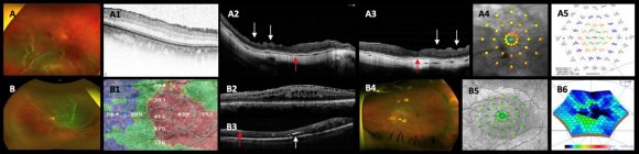 Figure 6: Postoperative structural and functional findings (part 3). (A) Optos photo of a failed gas-vitrectomy in rhegmatogenous retinal detachment (RRD)(case 78). (A-1) Corresponding macula scan after vitrectomy revision with postoperative epiretinal membrane proliferation with logarithm of the minimum angle of resolution of 1.0 units; the eye underwent a third procedure for ERM-internal limiting membrane removal; final BCVA is 0.70 logMAR. (A-2) and (A3) Foveal crossline depict retinal thinning and dimpling of the superficial nerve fiber layer (white arrows) due to dissociated optic nerve fiber layers defects and loss of foveal contour; the ELM line and ellipsoid show irregular reflectivity (red arrows). (A-4) Macular microperimetry with a reduction in macular retinal sensitivity (MRS); the retinal sensitivity analysis shows abnormal integrity. (A-5) Abnormal multifocal electroretinography (mfERG) response with N1 wave amplitude reductions. (B) An Optos photo of a primary RRD undergoing an uneventful 360-degree 503 round sponge buckling-cryotherapy with subretinal fluid drainage; After 6 weeks, macular thickening associated with epiretinal membrane (ERM) proliferation is depicted in (B-1), with diffuse retinal thickening in the abnormal topographic retinal map.(B-2) Corresponding horizontal scan depicting diffuse macular thickening associated with ERM proliferation and wrinkling of the inner superficial retina layers; multiple deep cystic spaces (sponge-type) and submacular fluid are seen; although the ellipsoid band appears preserved, the ELM line is not; final BCVA is 0.90 logMAR. (B-3) After ERM-ILM removal, the BCVA is 0.70 logMAR. The macula looks atrophic; there are hyper reflective deep lines (white arrow) and ILM remnants (red arrow); no evidence of the ELM and ellipsoid are found. (B-4) An Optos, wide-angle photo of the corresponding cases shows substantial, but non-significant, visual improvement (case 43; peeling dataset). (B-5) The corresponding microperimetry shows subnormal macular integrity with subnormal MRS; stable foveocentral fixation is seen.(B-6) Abnormal three-dimension topographic map of the corresponding abnormal mfERG.