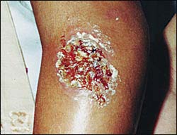 Figure 3: Symptoms of Zoonotic Cutaneous Leishmaniasis (ZCL)