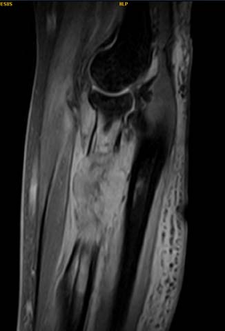 Comparitive Study between Kapandji and Extra-Focal Fixation in Extra Articular Distal Radius Fractures