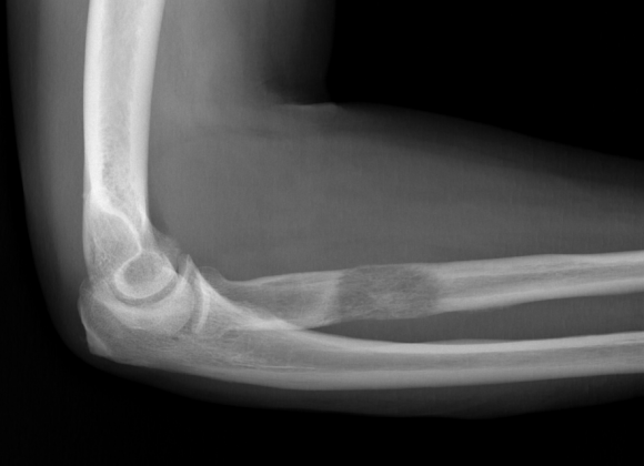 Figure 2: Sagittal image (A) and axial (B) of the pre-operative MR of the right elbow, which shows bone invasion and the extension of the associated soft-tissue mass.