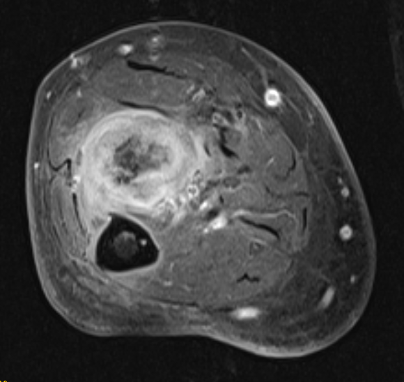 Figure 4 A. Tumor resection of the proximal radius with soft-tissue mass. B. Bone bank allografts used for bone reconstruction of the post-resection defect. C. Intraoperative image after reconstruction and osteosynthesis. D. Postoperative AP and LAT Radiological image of the right elbow.