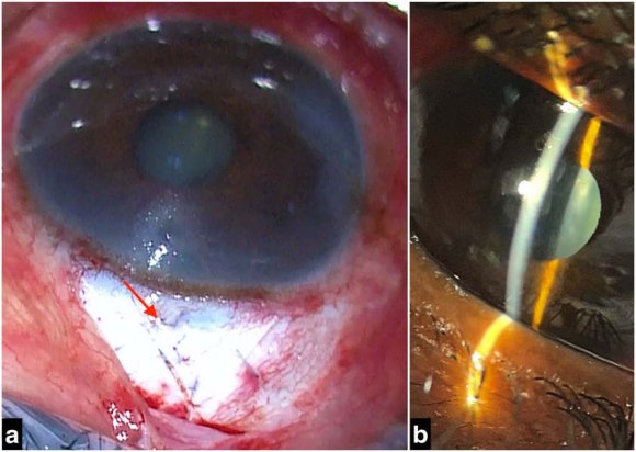 Figure 1: (a) Image showing a well-constructed triangular trabeculectomy flap of adequate thickness. (b&c) Consecutive images reveal immediate leakage of fluid through the suture tract (red arrow) after Weck-cel sponging, despite efforts made in repairing the leak with multiple sutures. (d) Image showing expanded polytetrafluoroethylene (e-PTFE) Gore-Tex (yellow arrow) material used as patch graft. (e) Image showing Gore-Tex anchored to the sclera over the leakage site. (f) Image showing conjunctival closure over the Gore-Tex area.