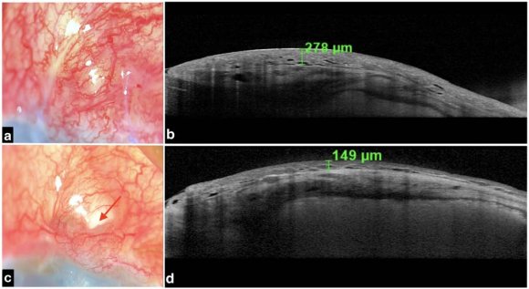 Figure 2: (a) Image showing intra-operative shallowing of the anterior chamber (AC) due to leak from the suture tract in the triangular flap area (red arrow) despite efforts made in repairing the leak with multiple sutures. (b) Slit-lamp photograph of 1st post-operative day revealing a well-formed AC following Gore-Tex implantation.