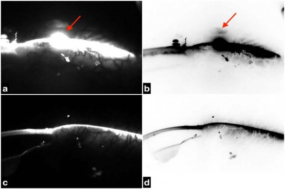 Figure 4: (a&b) Scheimpflug imaging of the bleb showing increased optical blooming (red arrows) in normal & inverse colour respectively at one-month post-operative period. (c&d) Scheimpflug imaging of the same section of the bleb showing reduced optical blooming, depicting signs of implant extrusion in normal & inverse colour respectively, at the three-month follow-up period.