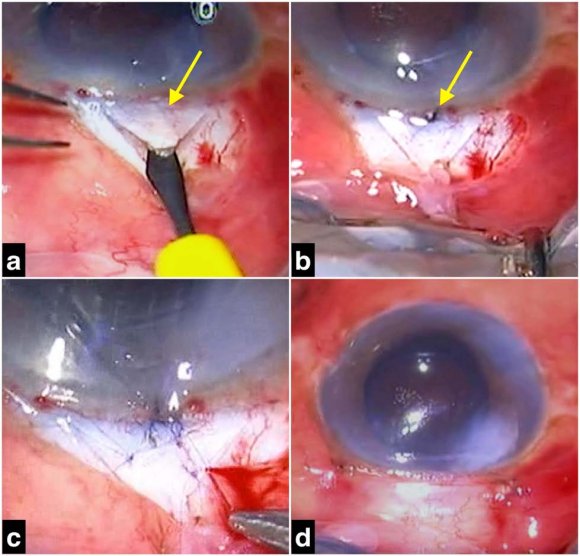 Figure 5: (a) Primary surgery revealing the AC entry step with 15°side port blade (yellow arrow). (b) Full-thickness scleral flap tear (yellow arrow) near the limbus caused by the paracentesis blade, due to the patient's sudden jerky head movement. (c) Closure of the flap tear with sutures at the limbal site. (d) End of the surgery showing a formed intra-operative AC.