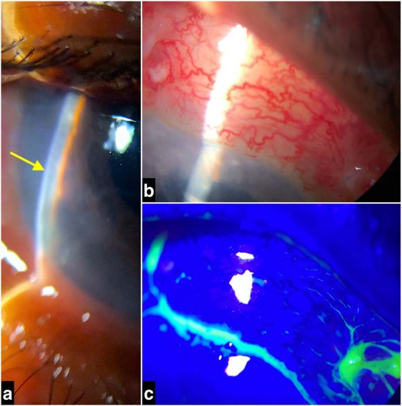 Figure 6: (a) Slit-lamp examination revealing flat AC (yellow arrow) at the 5th post-operative day, which never recovered from day one post-surgery despite conservative management. (b) Slit-lamp examination showing overfiltering large bleb with no leak. (c) Slit-lamp examination confirming the absence of bleb leak with negative Seidel test on fluorescein staining.