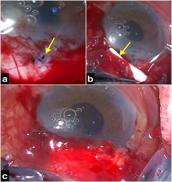 Figure 7: Re-surgery at day 5. (a) Intra-operative image showing the gaping flap tear (yellow arrow) between the AC and sub-conjunctival space at the site of limbus, which occurred due to the patient's jerky head movement, during the step of entry into the AC with the paracentesis blade. (b) Gore-Tex implant sutured over the flap tear by anchoring it to the underlying sclera. (c) End of surgery image revealing a well-formed AC.
