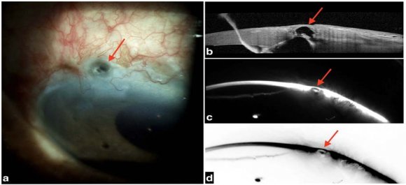 Figure 8: (a) Slit-lamp photograph at 1-month post-operative follow-up showing extrusion of Gore-Tex with a fistula between the AC & sub-conjunctival space (red arrow), without any bleb leak and a well-formed AC. (b) AS-OCT showing similar communication between the AC & sub-conjunctival space with the thin layer of conjunctival covering over it (red arrow). (c &d) Scheimpflug image revealing the same communication (red arrows).