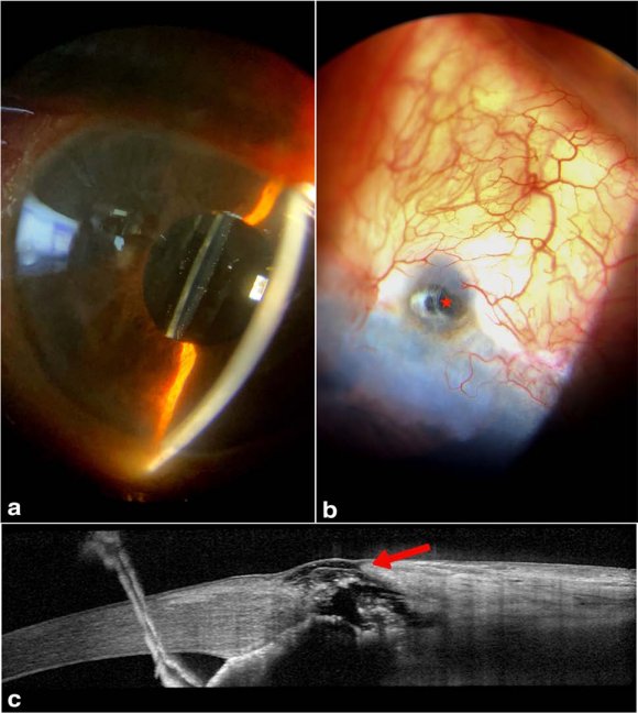 Figure 9: (a) Slit-lamp photograph at 6-month post-operative follow-up showing a well-formed AC with (b) cicatrisation (red asterisk) of the fistulous tract. (c) AS-OCT confirms the cicatrisation of the fistula (red arrow)