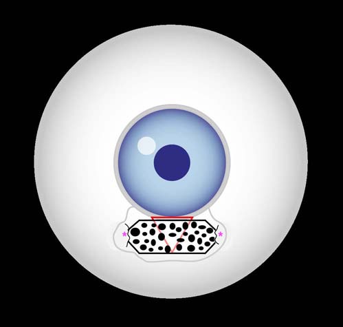 Figure10: Placing a perforated Gore-Tex implant by creating two intra-scleral pockets (pink asterisk), with an extension of at least 0.5 mm, followed by tucking the edges of the trimmed Gore-Tex into it, for better stability and tolerability.
