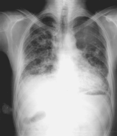 Fig. 10(a): Descarga da mistura moída com solvente aromático; (b) Moinho Attritor de alta energia; e (c). fechamento da válvula do moinho Atrittor e decantação para separação do sólido e líquido. Após a decantação e a retirada do excesso de líquido do recipiente, a carga é colocada em cima de um carrinho de transporte, Fig. 11 (a), para o setor de secagem. Na Fig. 11 (b), o trabalhador retira o pósmetálico umedecido do recipiente, na forma de lama, colocando em muflas abertas para vaporização do solvente, no qual denomina-se "Banho Maria". Após algumas horas de secagem, Fig. 11(c), o trabalhador recolhe o pó seco, a uma temperatura de aproximadamente 120ºC. Neste setor, percebe-se um odor muito forte de solvente no meio ambiente de trabalho.Na etapa de vaporização o operador foi exposto aos agentes nocivos como: vapores aromáticos gerados pelo processo de secagem e inalação de pósmetálicos. Há registros de incidentes neste setor, princípios de incêndio, queima dos pós-metálicos e riscos de explosão devido a quantidade de vapores.